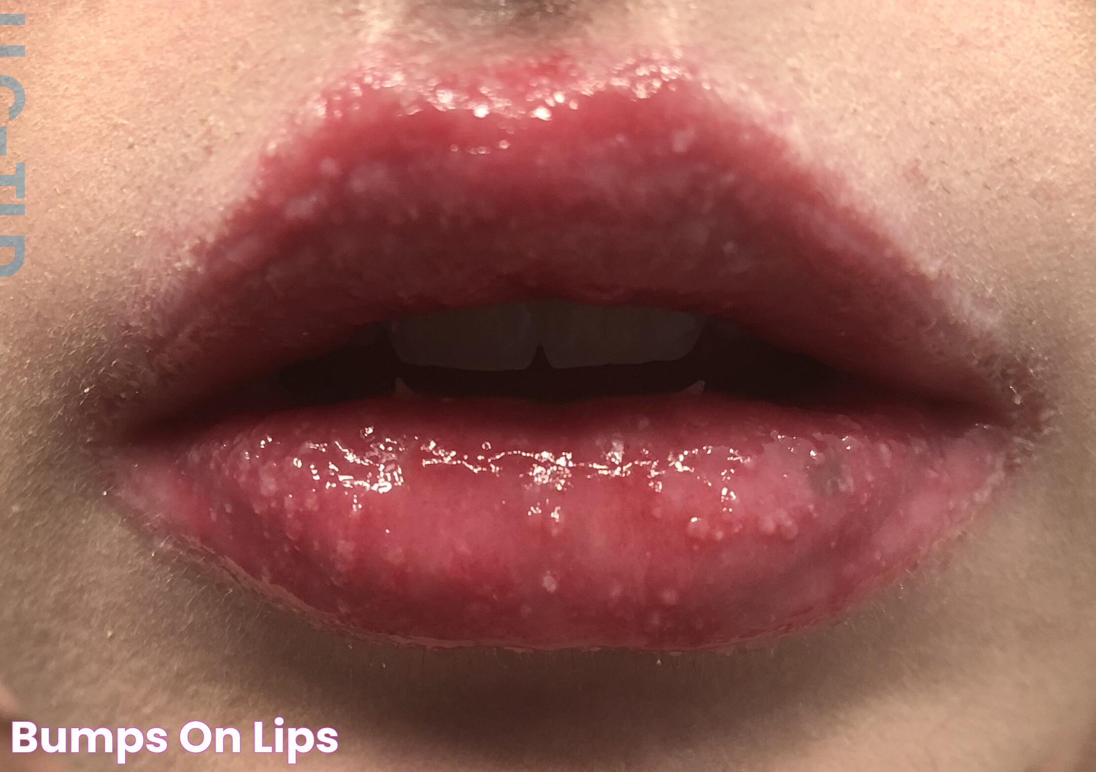 Effective Solutions For Bumps On Lips: Causes, Treatments, And Prevention