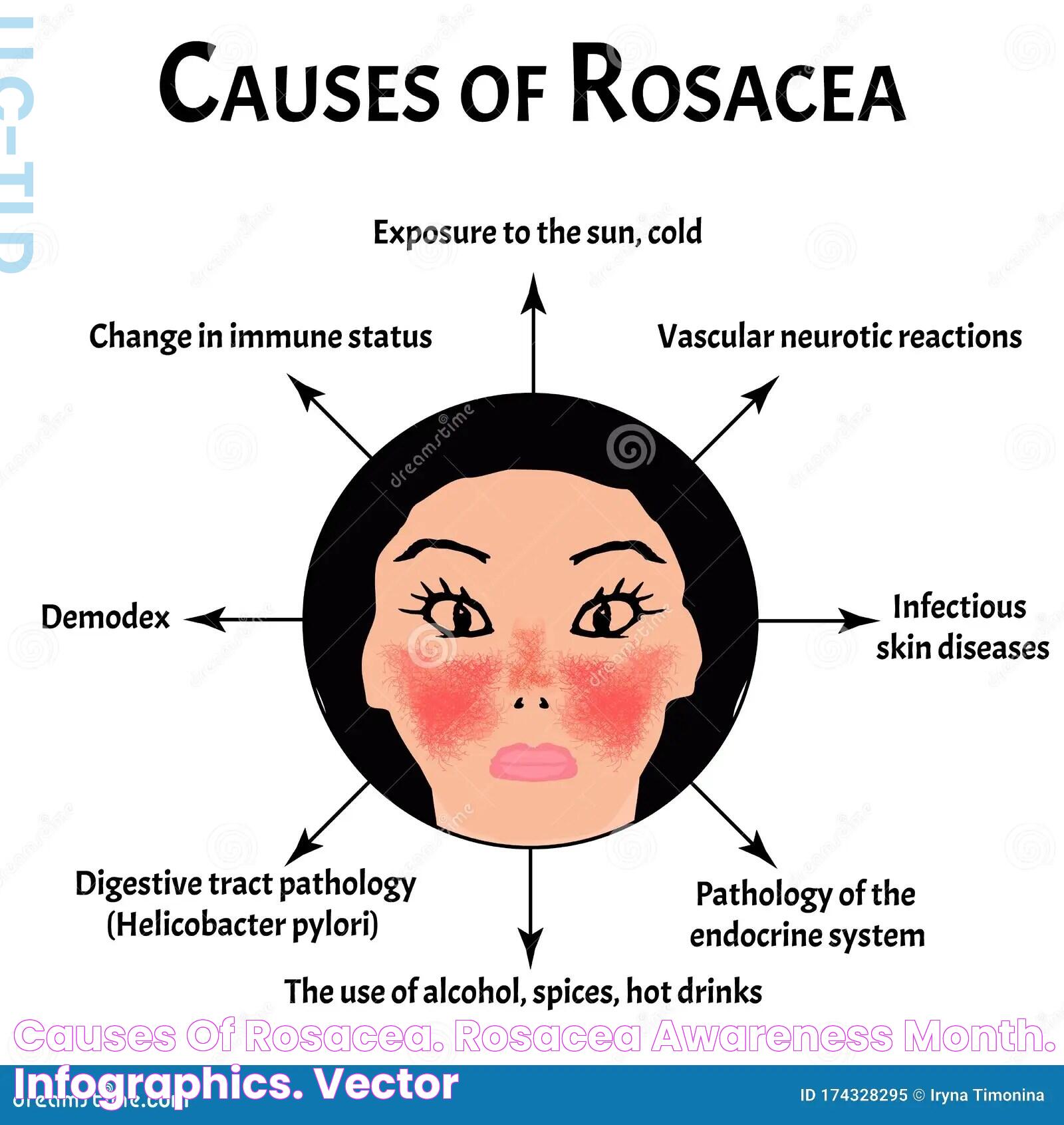 Causes of Rosacea. Rosacea Awareness Month. Infographics. Vector