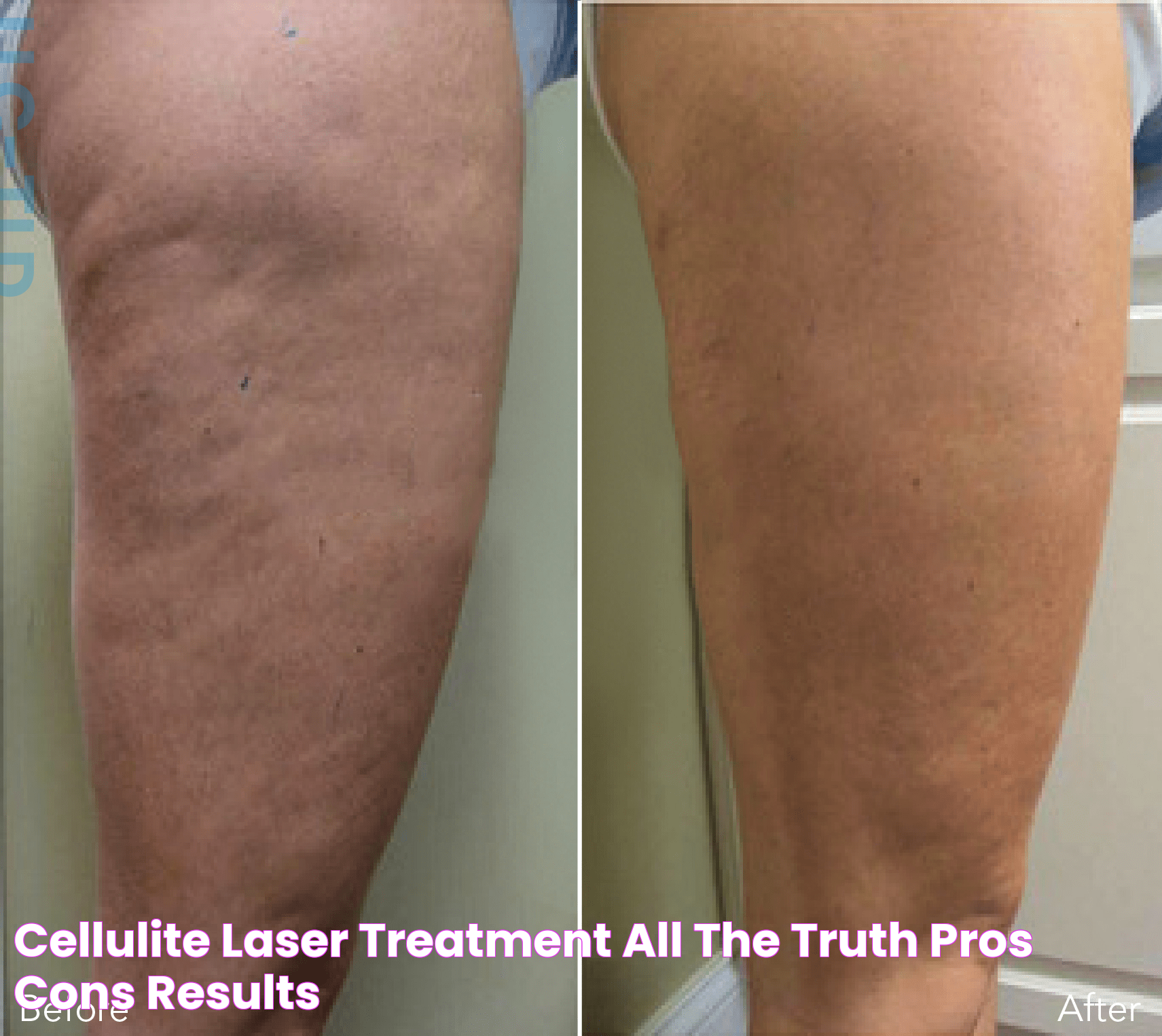 Effective Methods For Cellulite Treatment: Enhance Your Skin's Appearance