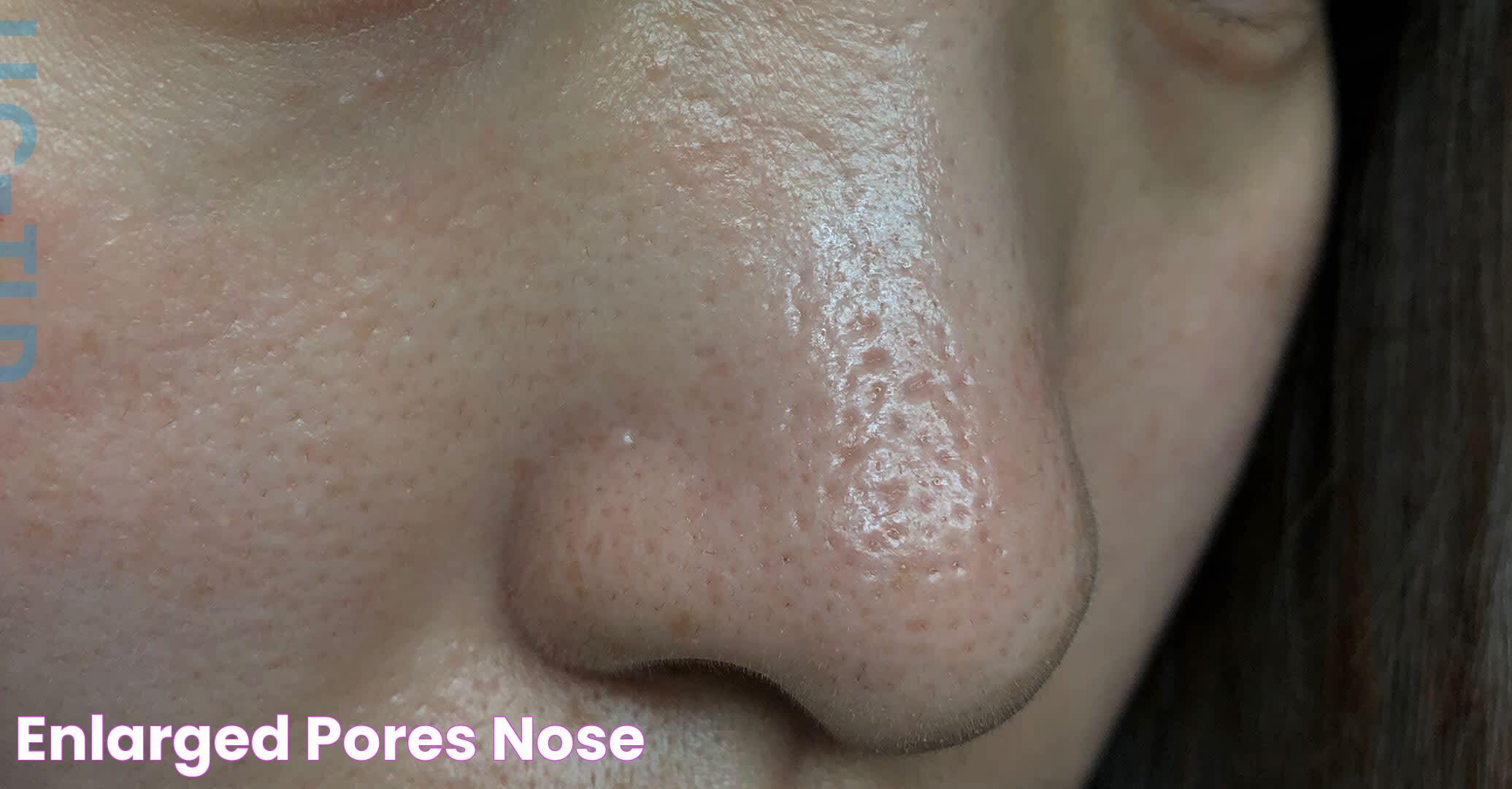 Enlarged Pores Nose