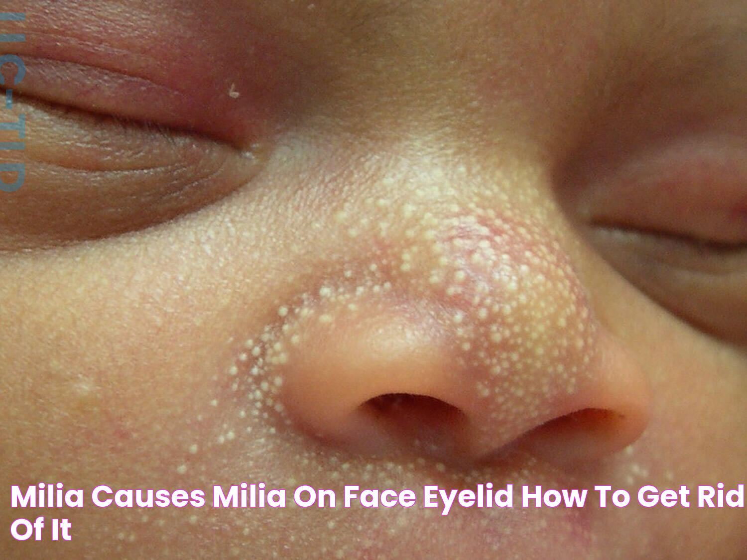 Milia Causes, Milia On Face, Eyelid & How To Get Rid of It