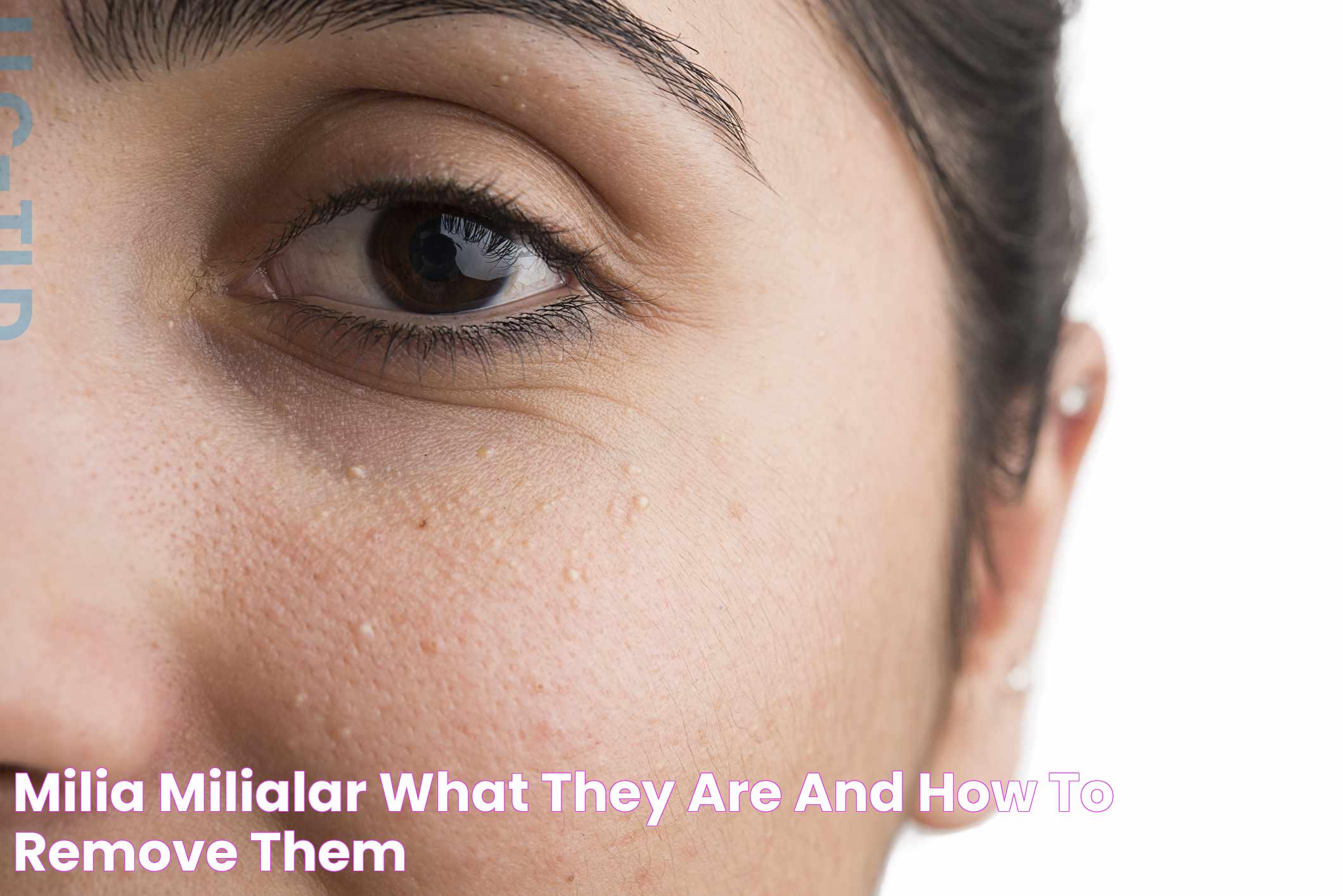 Milia (Milialar) What They Are and How to Remove Them