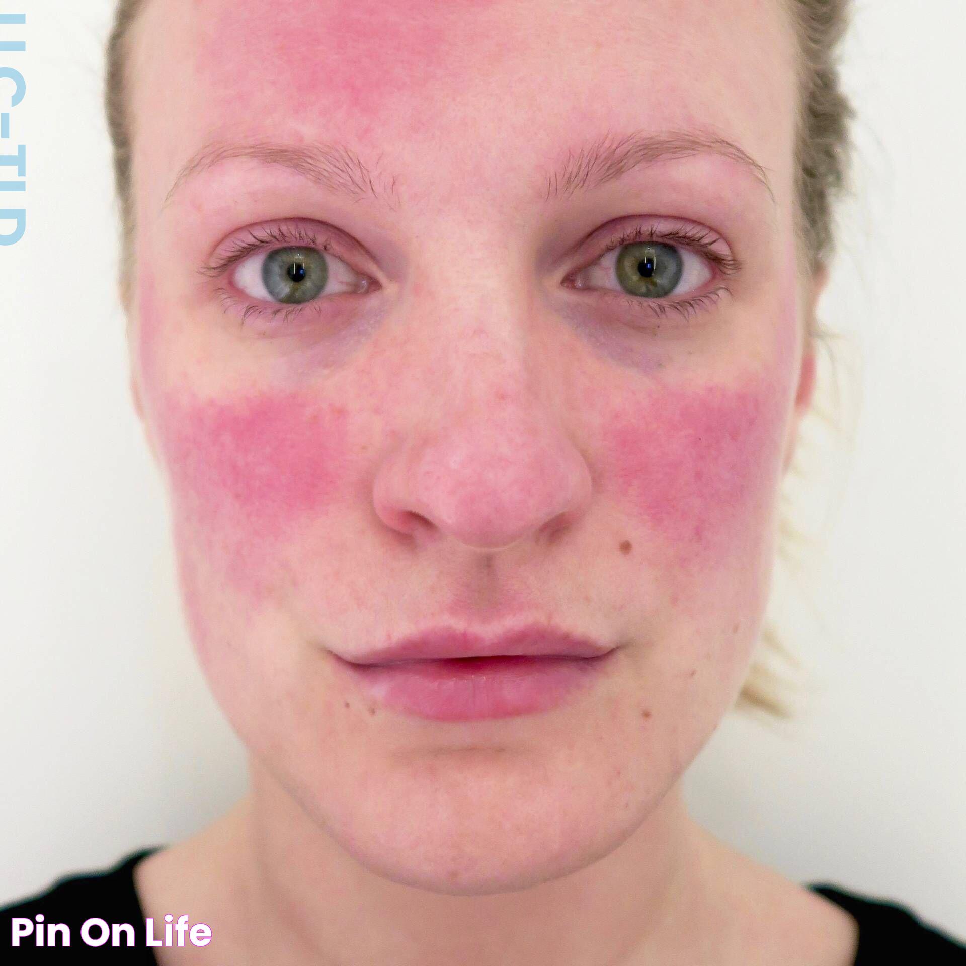 Decoding Rosacea Causes: A Comprehensive Guide To Understanding Triggers And Symptoms