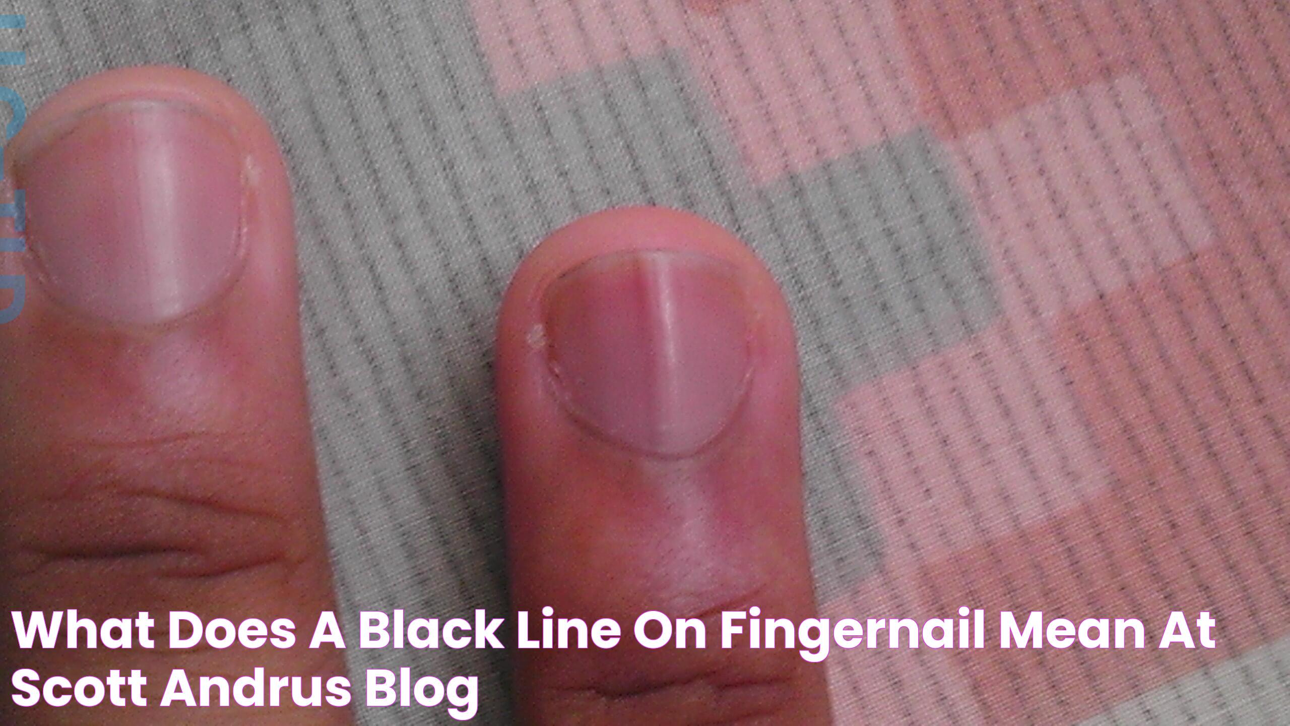 Comprehensive Insights Into Line In Fingernail Meaning: What You Need To Know