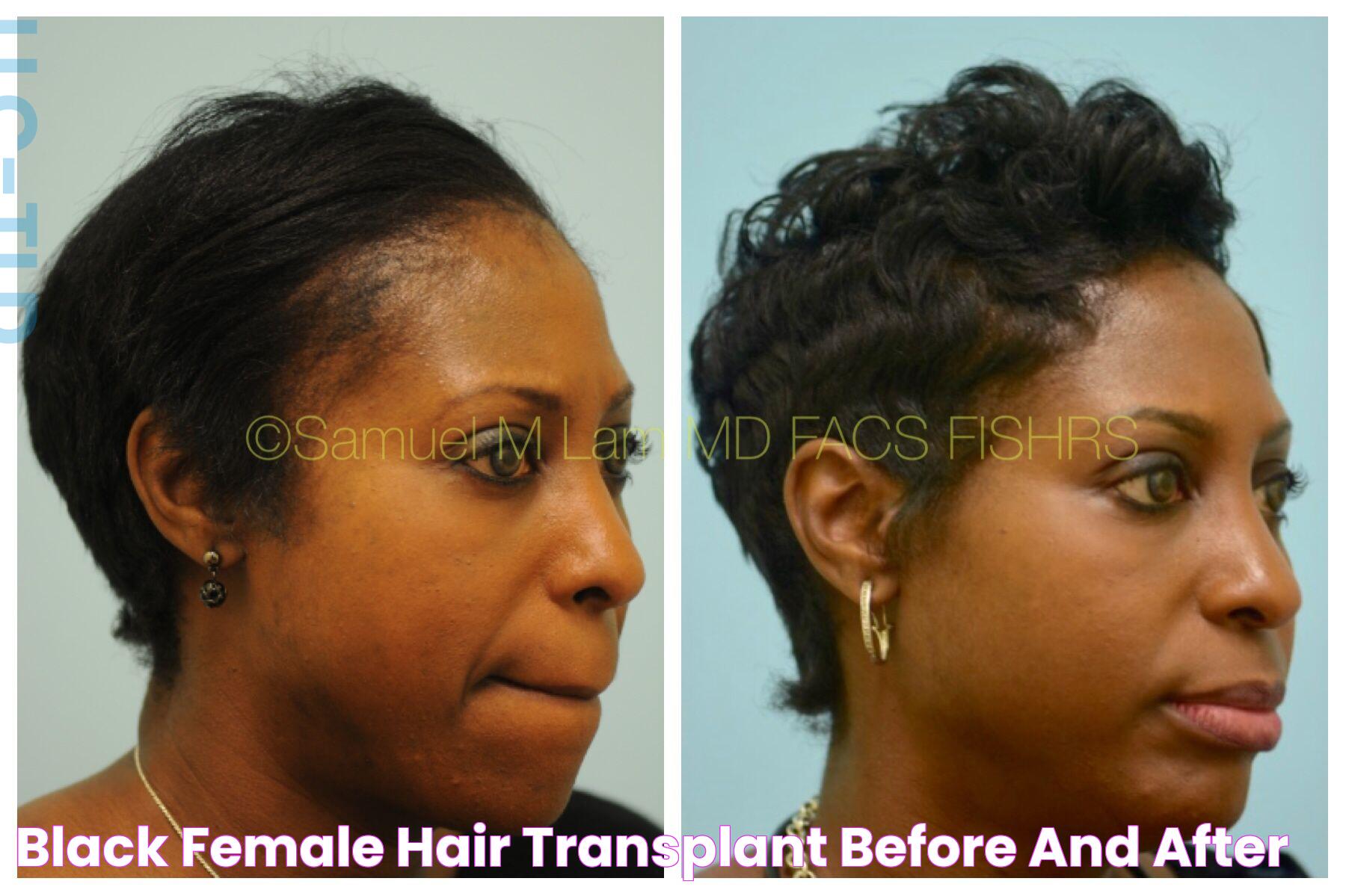 Transforming Lives: Black Female Hair Transplant Before And After Experiences