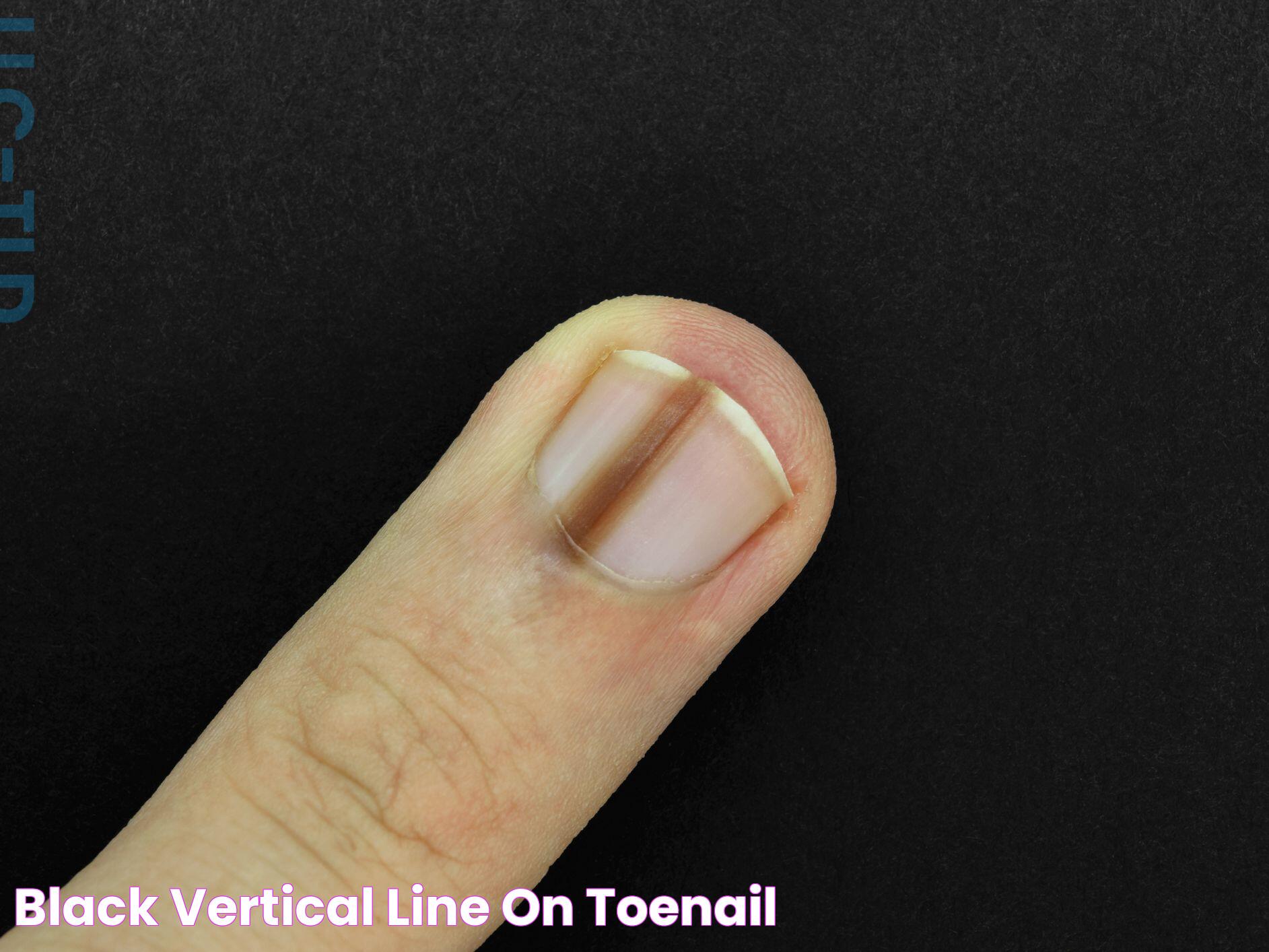 Vertical Toenail Lines: Causes, Treatments, And Prevention