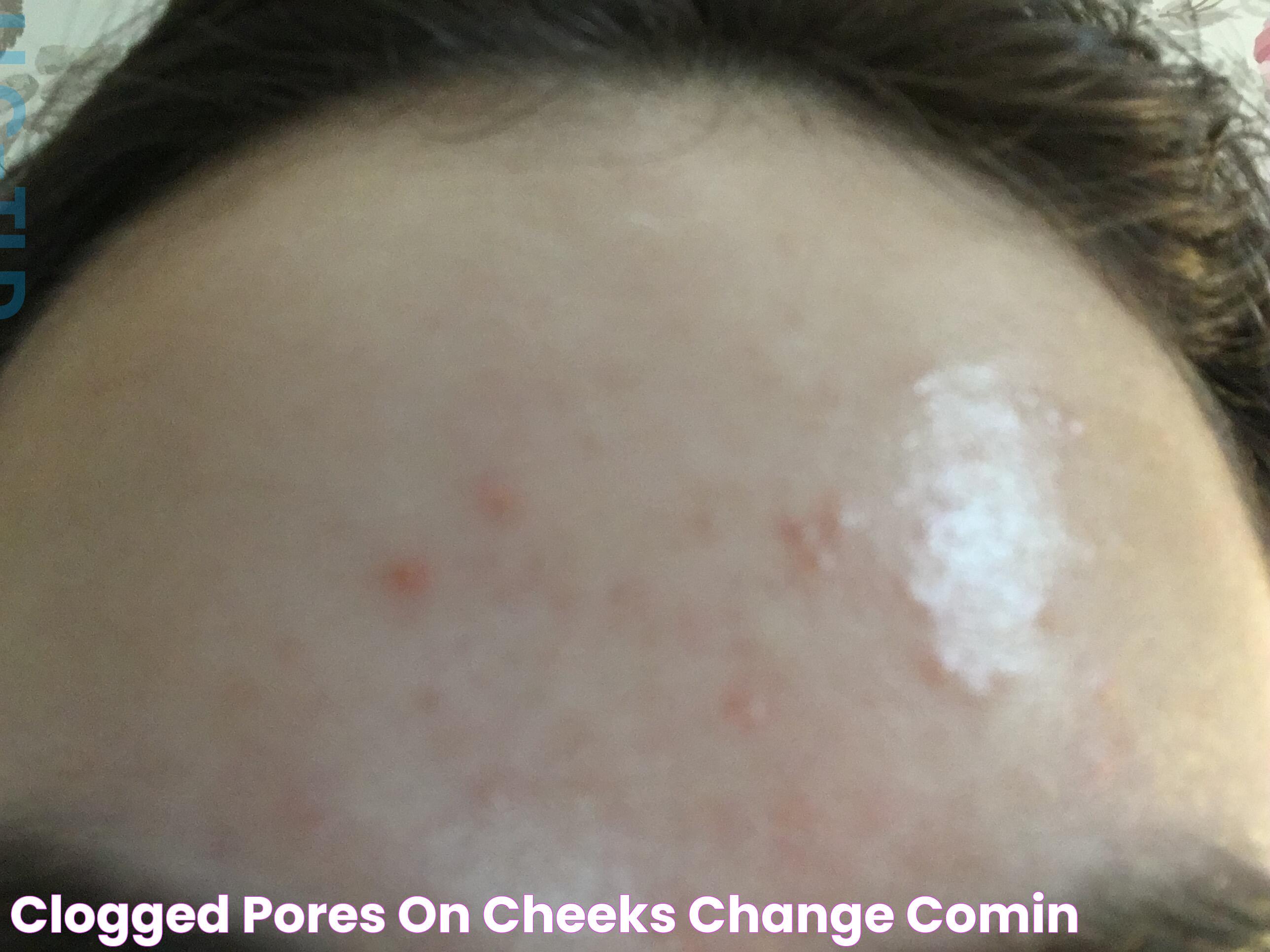 Effective Strategies To Minimize Pores On Cheeks: Tips And Tricks