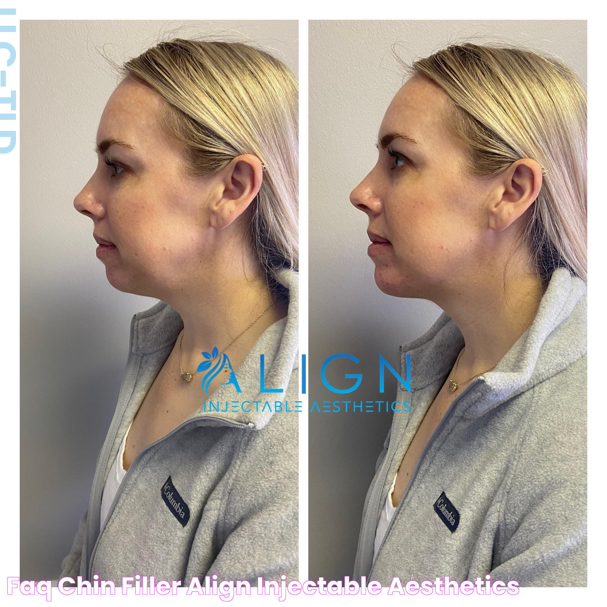 FAQ Chin Filler Align Injectable Aesthetics