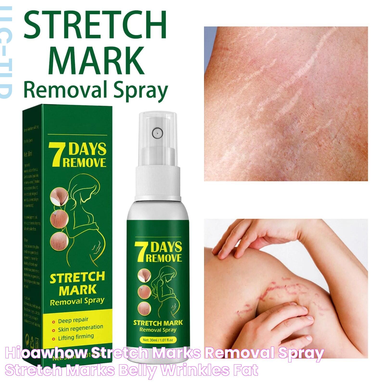 Unveiling The Mystery: Comprehensive Guide To Stretch Marks