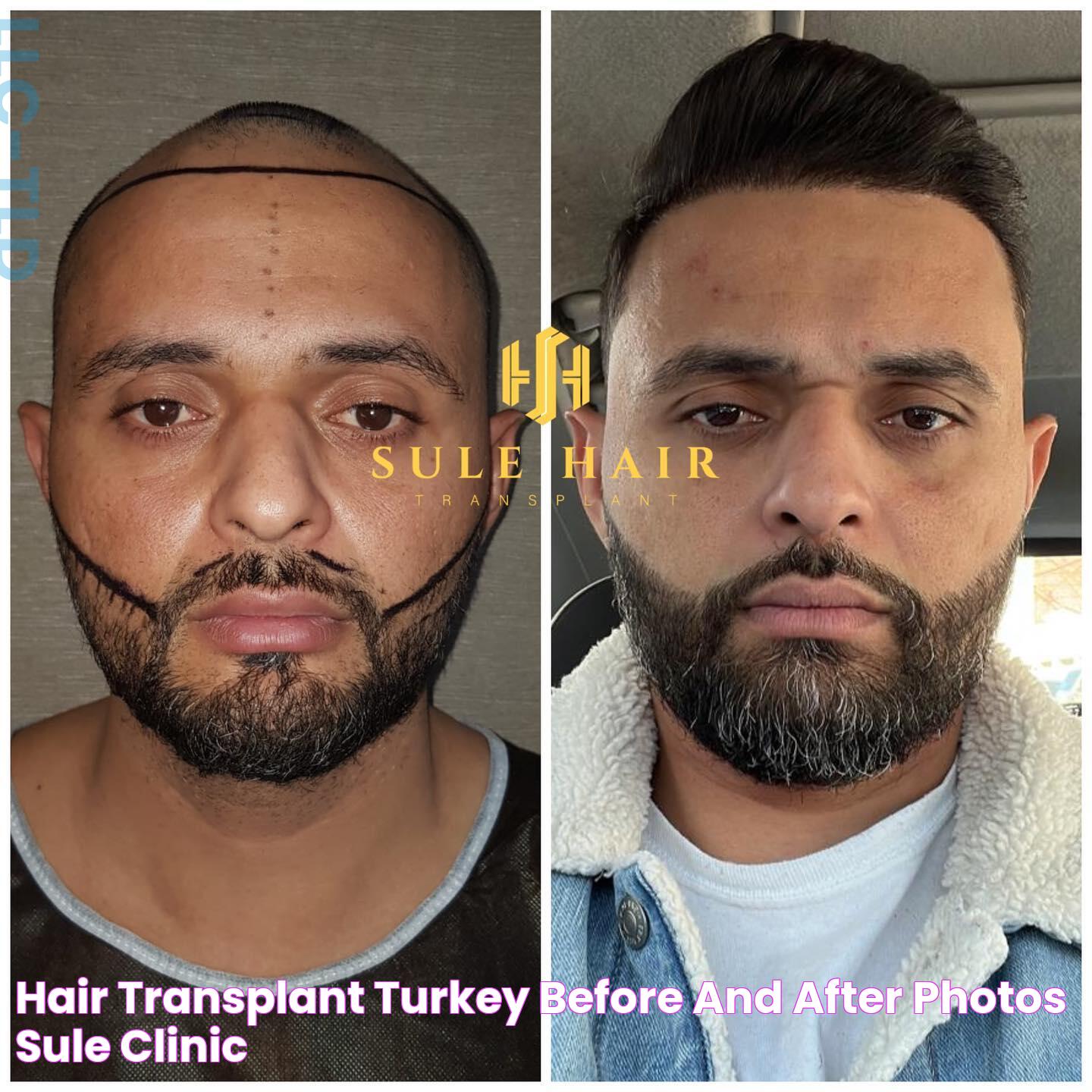 Hair Transplant Turkey Before and After Photos Sule Clinic