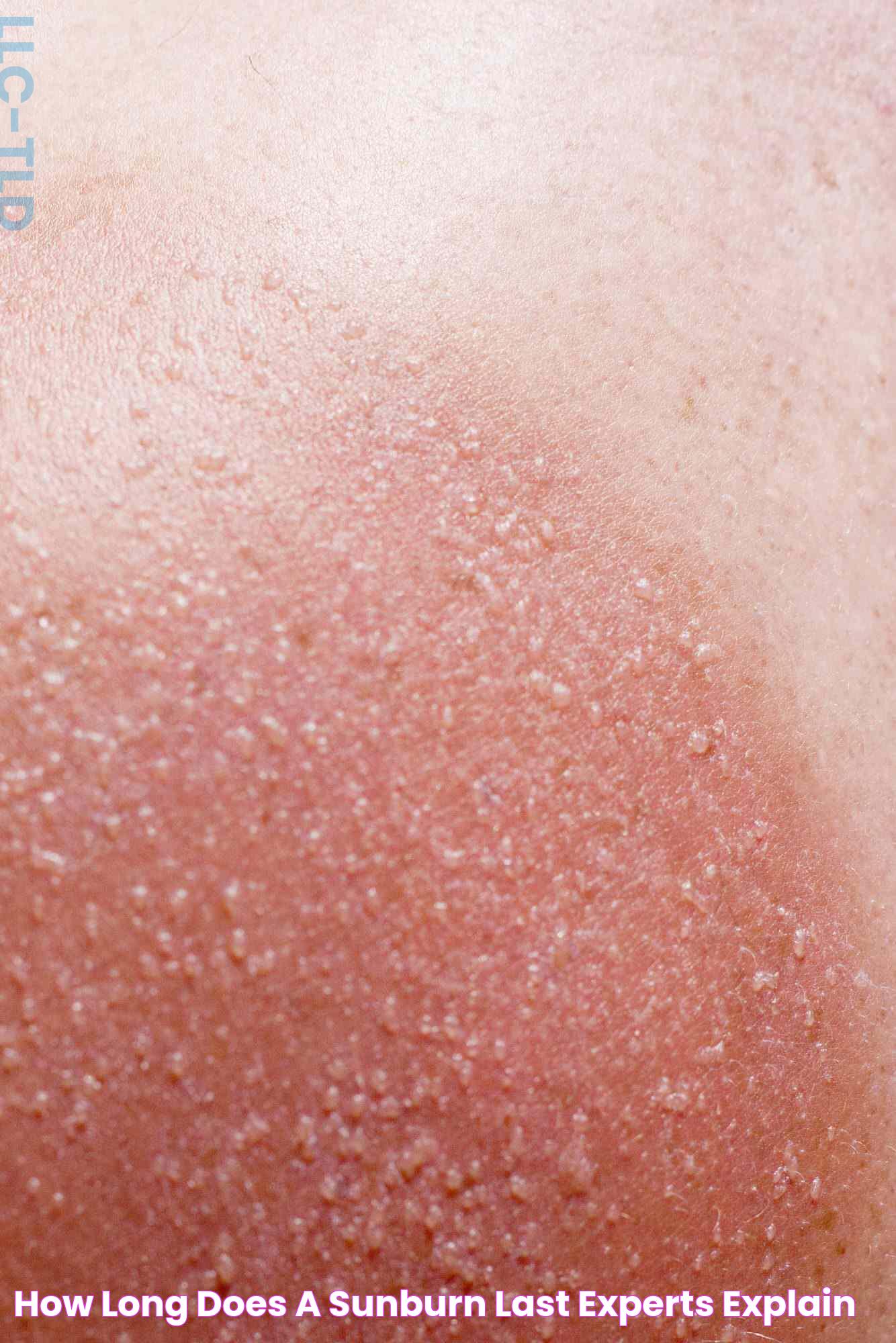 Sunburn Skin Bumps: Relief And Prevention Tips