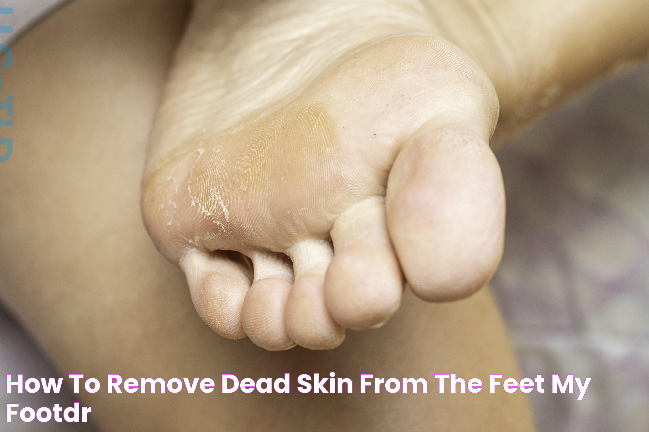 How To Remove Dead Skin From The Feet My FootDr