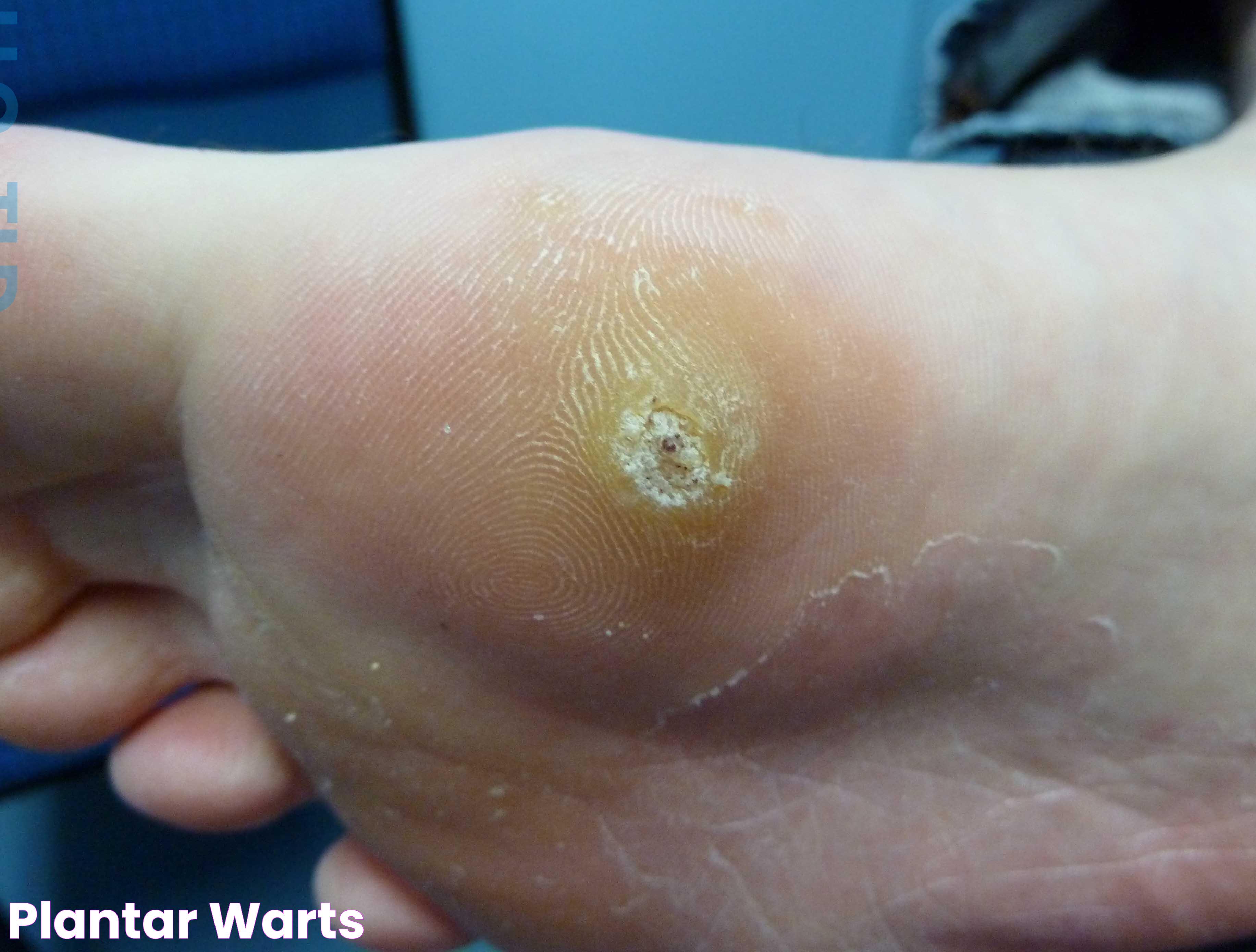 Plantar Warts