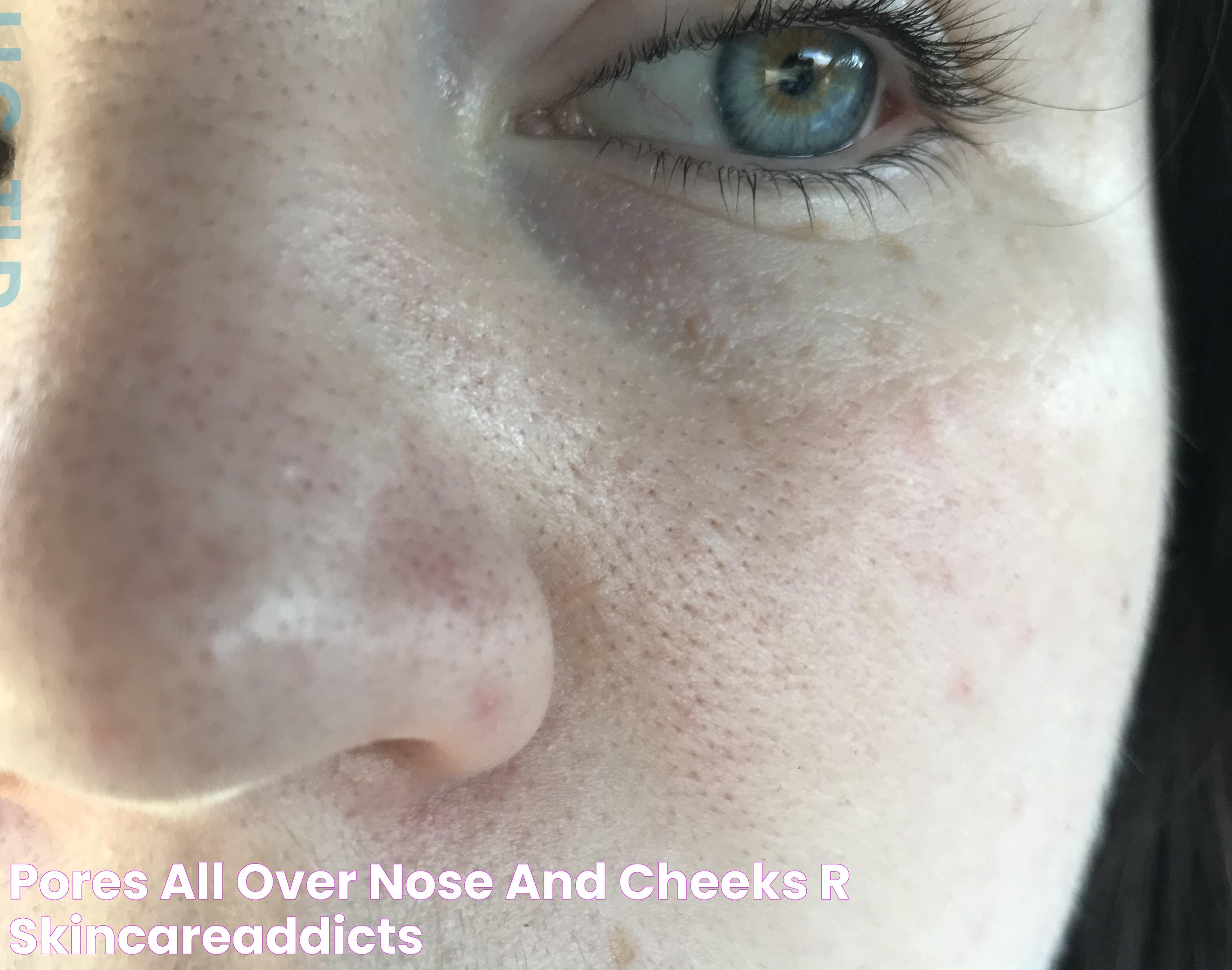 Pores all over nose and cheeks? r/SkincareAddicts