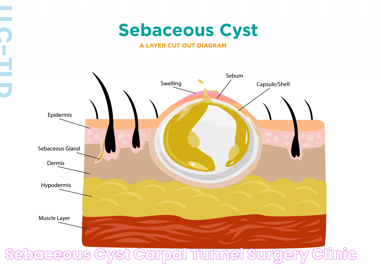 Sebaceous Cyst Carpal Tunnel Surgery Clinic