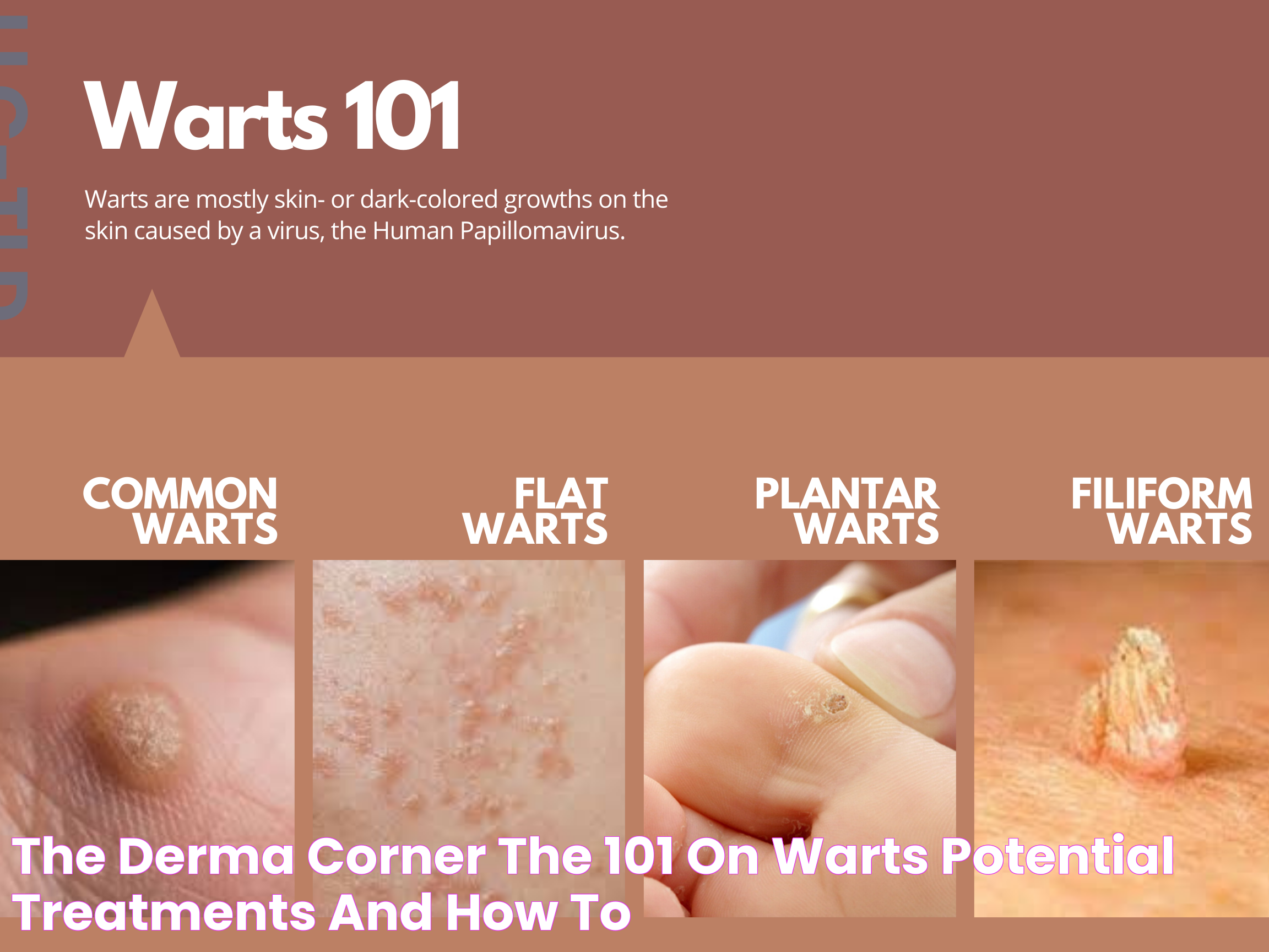 Various Types Of Warts: Causes, Treatments, And Prevention