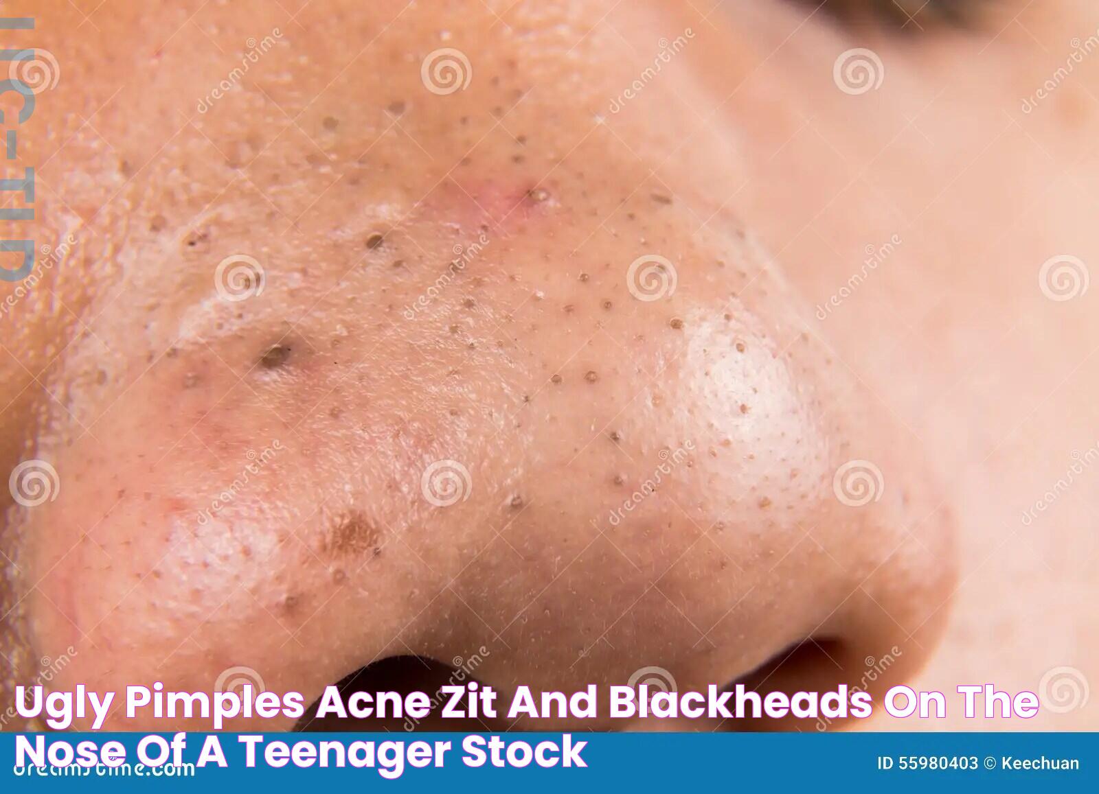 Ugly Pimples, Acne, Zit And Blackheads On The Nose Of A Teenager Stock