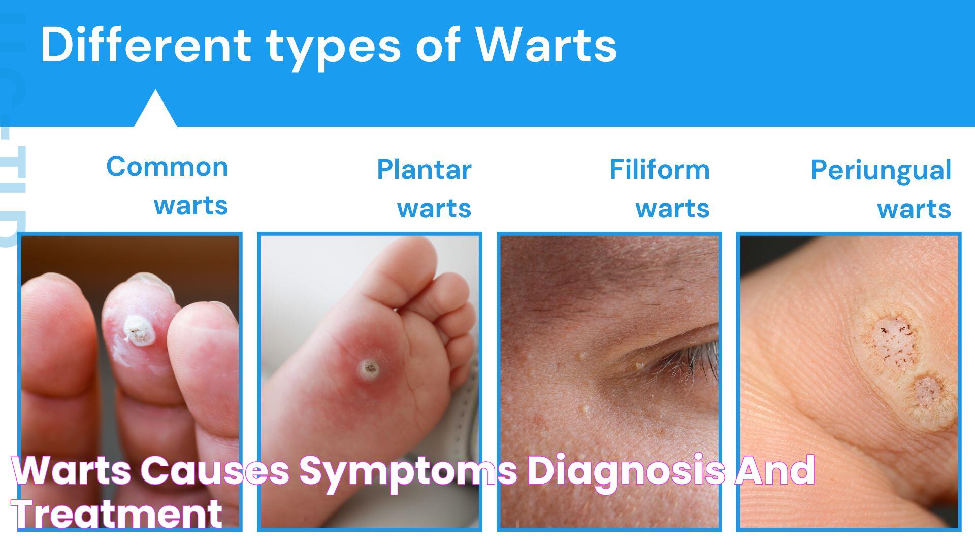 Warts And Their Roots: Mysteries And Realities Explained