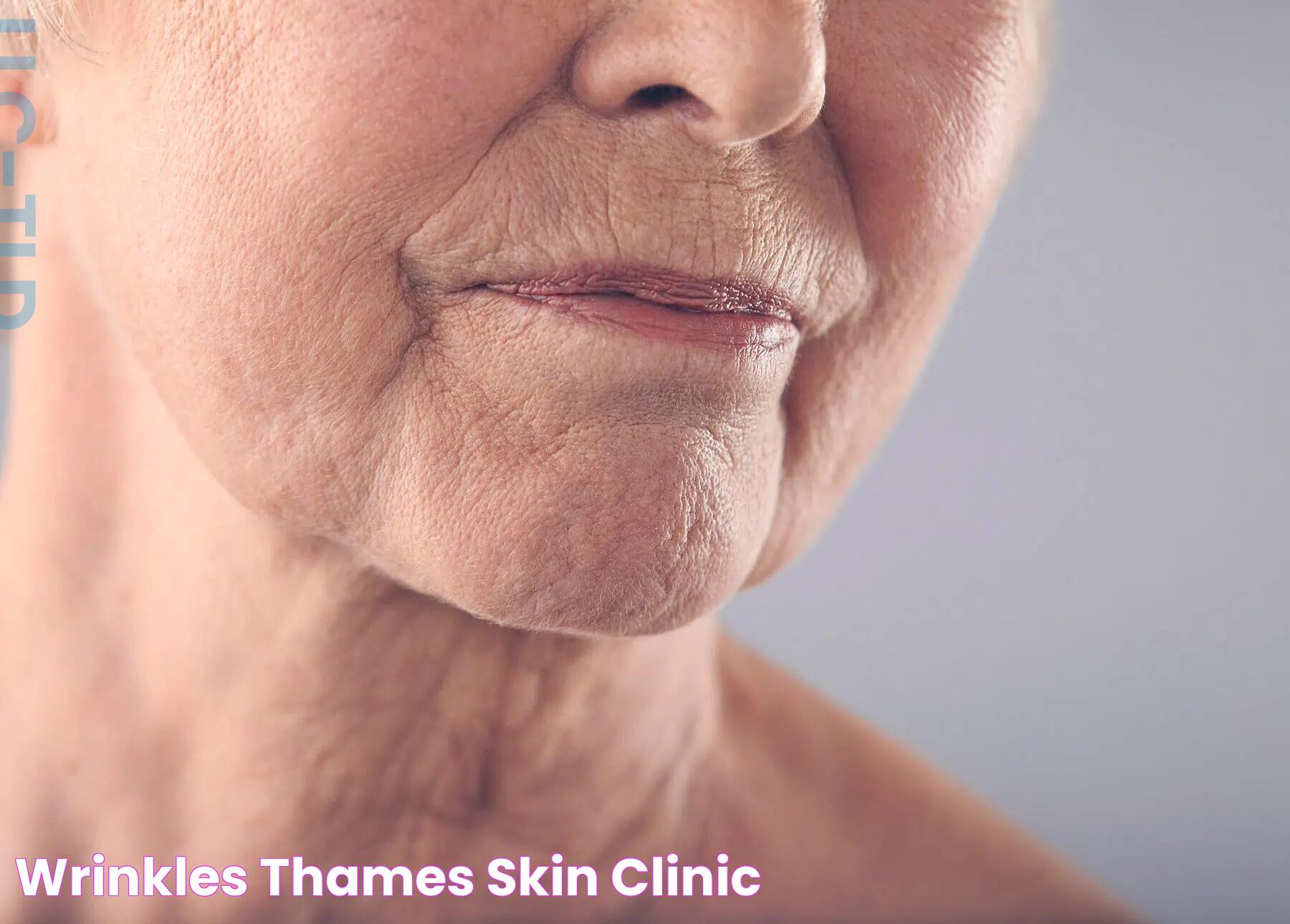 Wrinkles Thames Skin Clinic