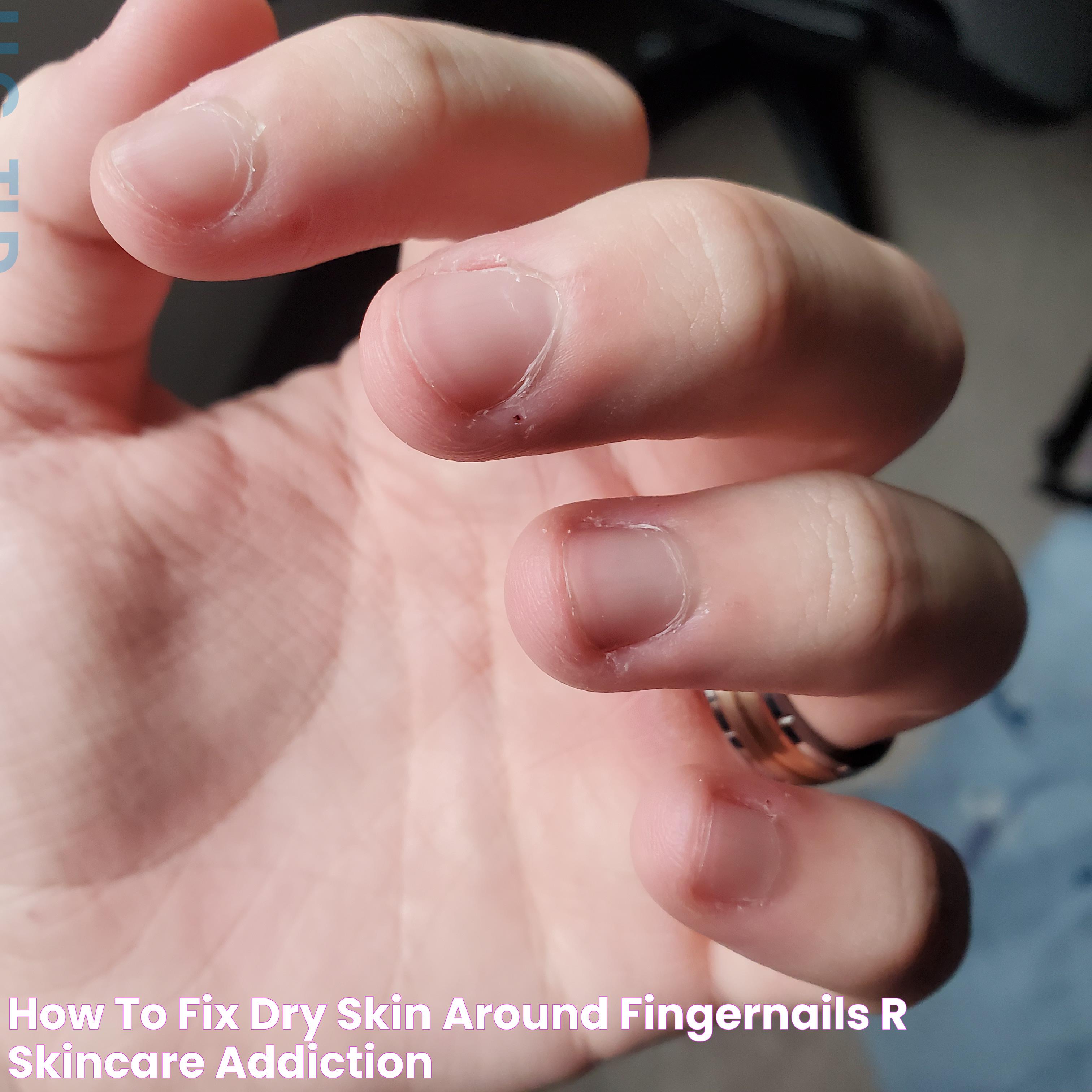 how to fix dry skin around fingernails? r/Skincare_Addiction