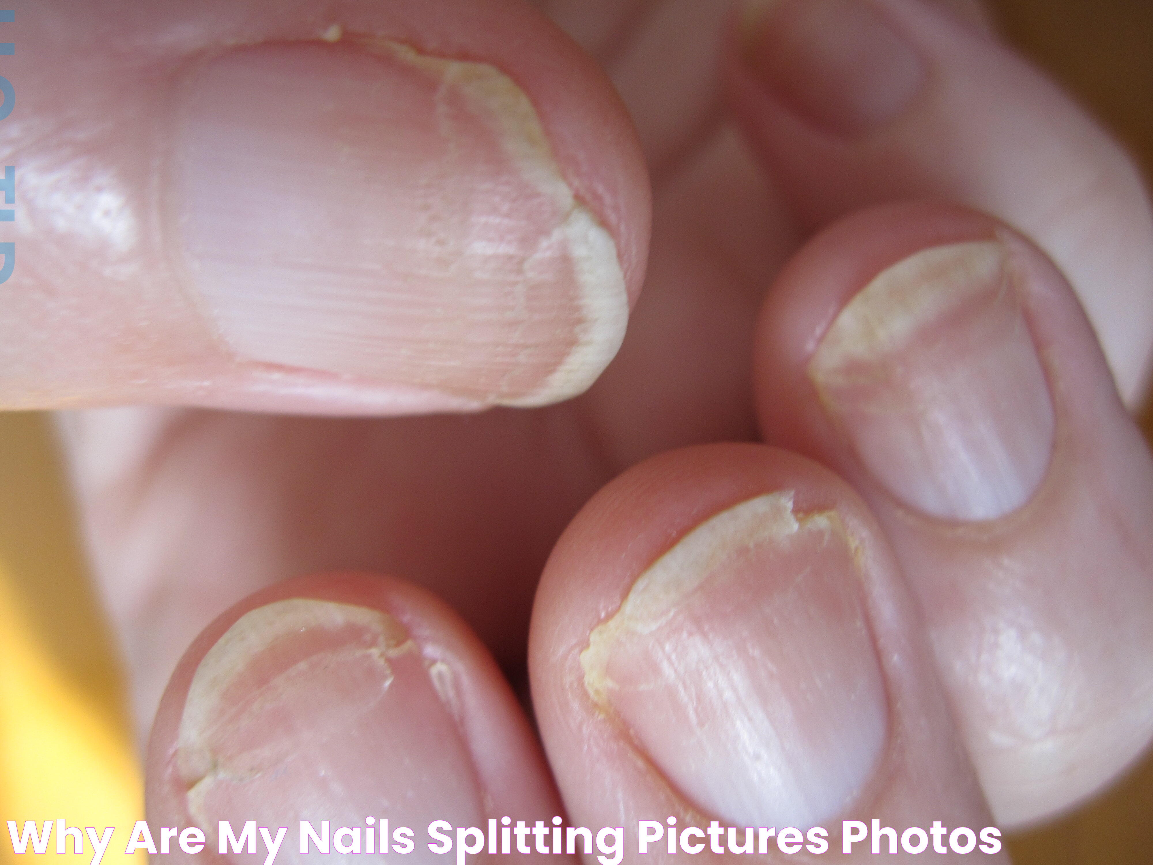 Cracking Nails: Causes, Prevention, And Treatment